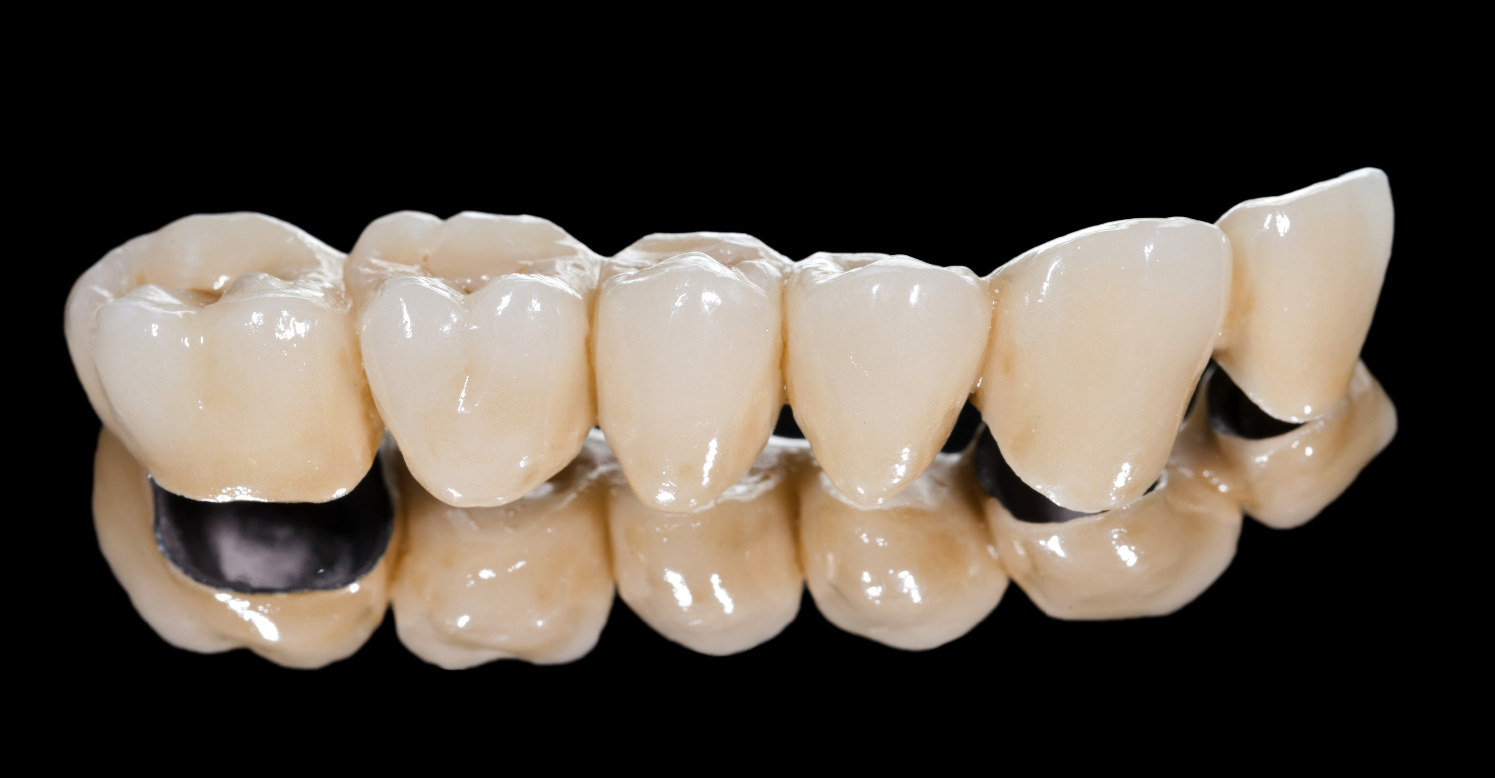 Crowns and bridges - Pinehurst Dental