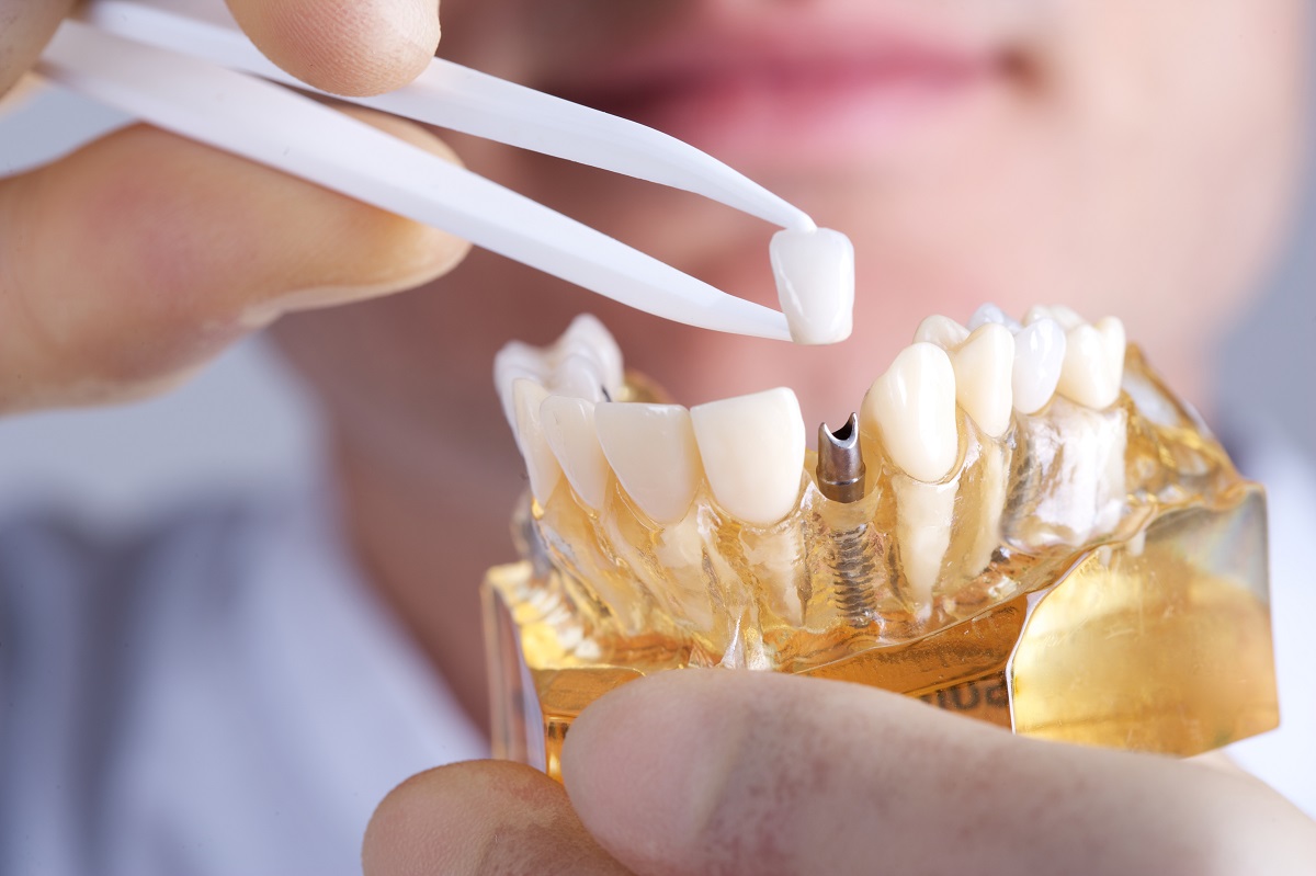 5 Important Facts about Dental Implants