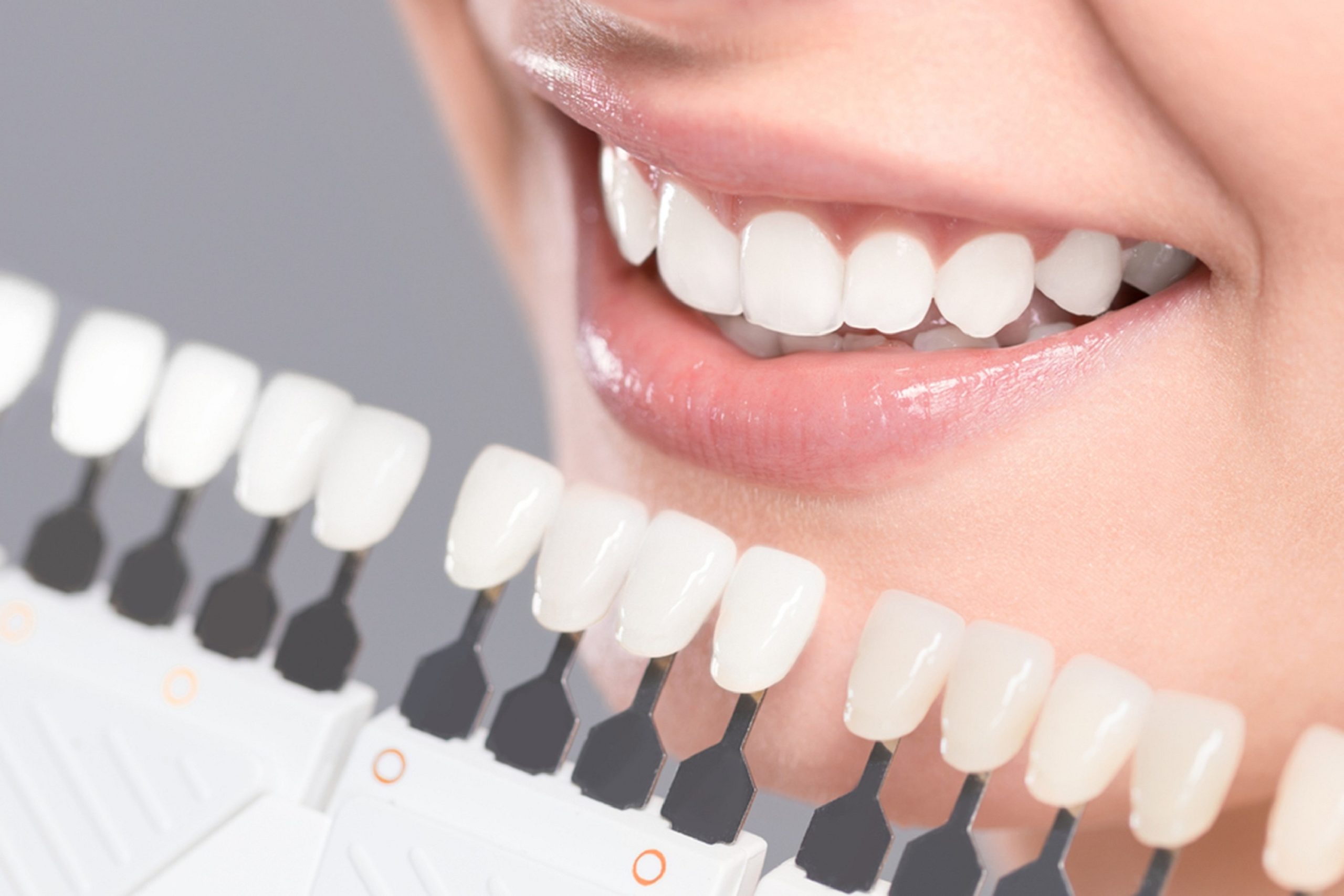 are-porcelain-veneers-stronger-than-real-teeth