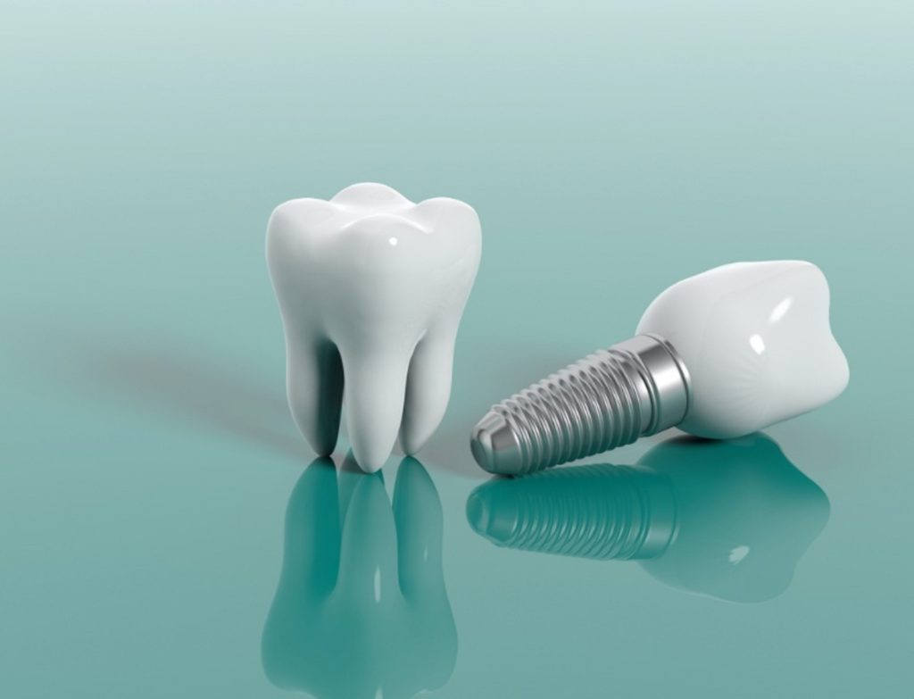 what-happens-if-you-do-not-have-enough-bone-for-dental-implants