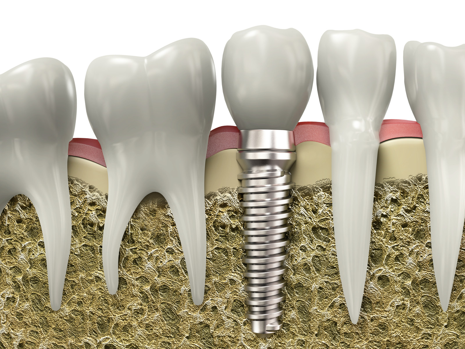 What do i do if my dental implant is loose?