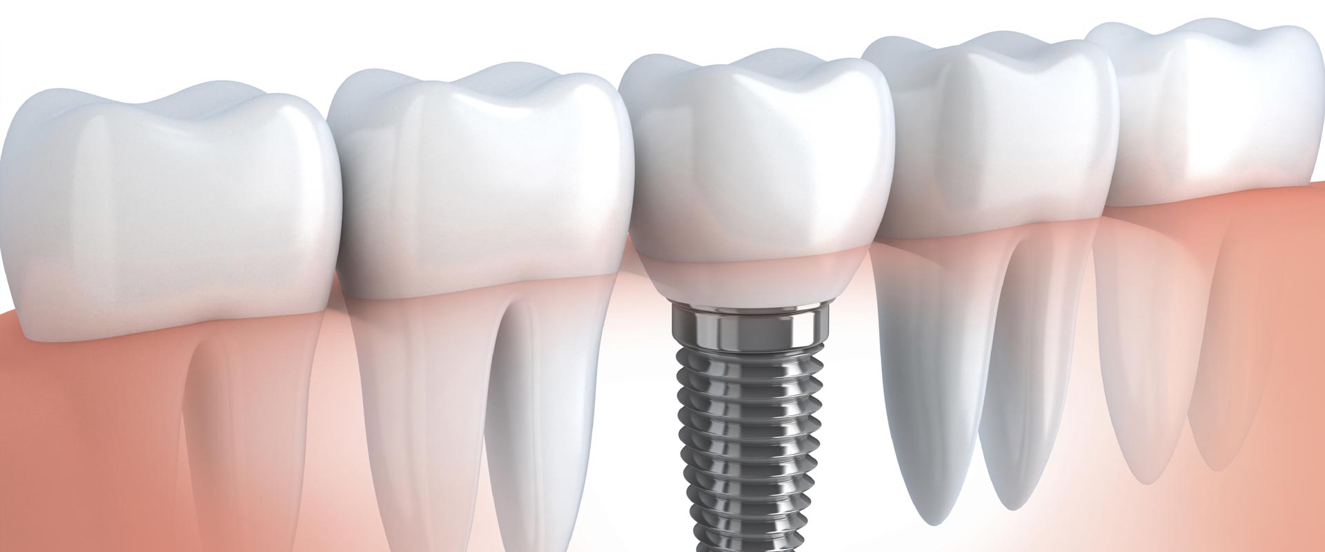 dental implants Edmonton