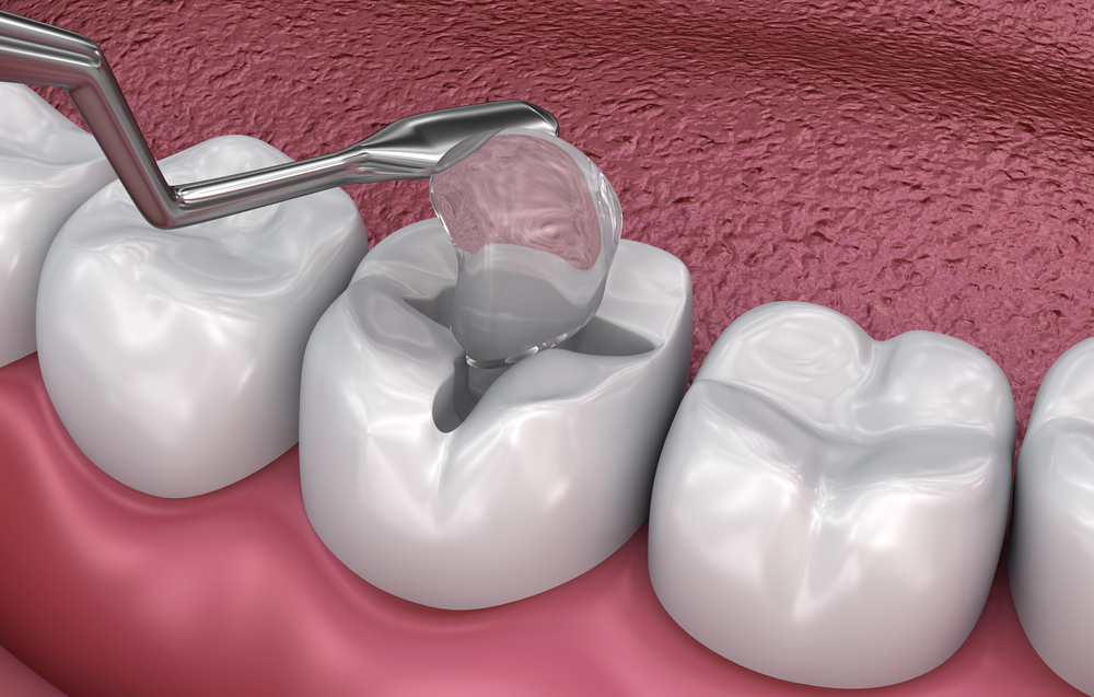 Composite Fillings in Edmonton