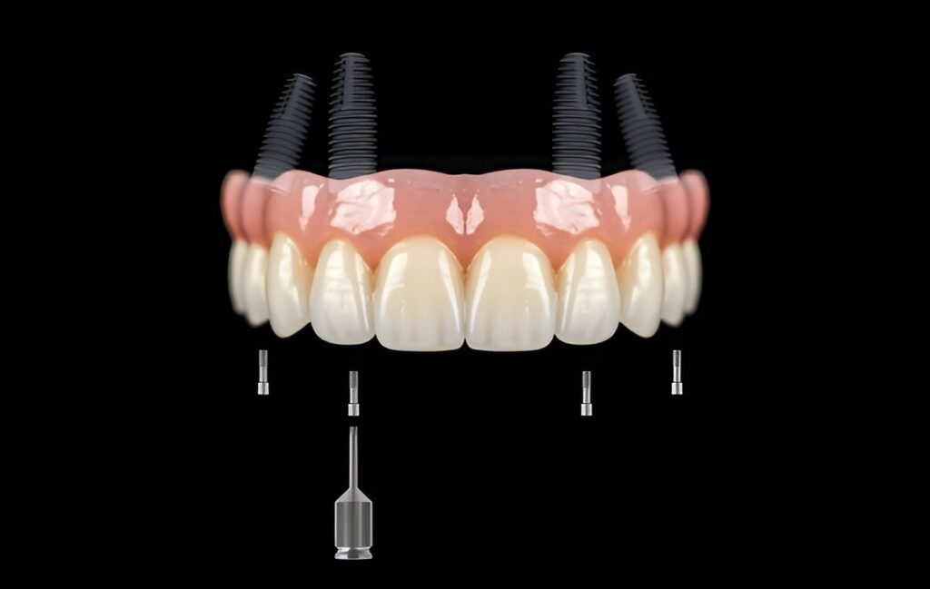 Dental Implants