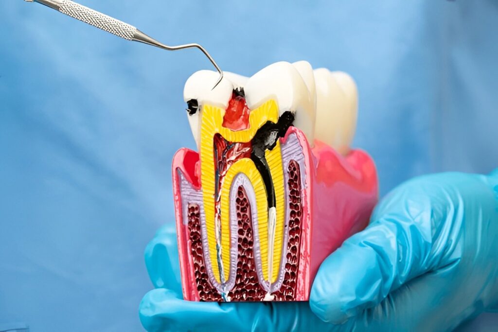 Root Canal Treatment in Edmonton