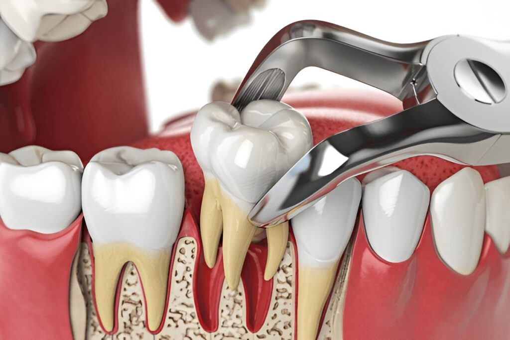 Tooth Extractions